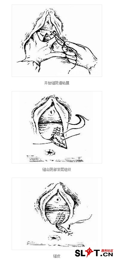 图解会阴侧切手术全程