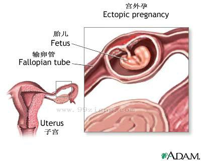 宫外孕无法用早孕试纸测出